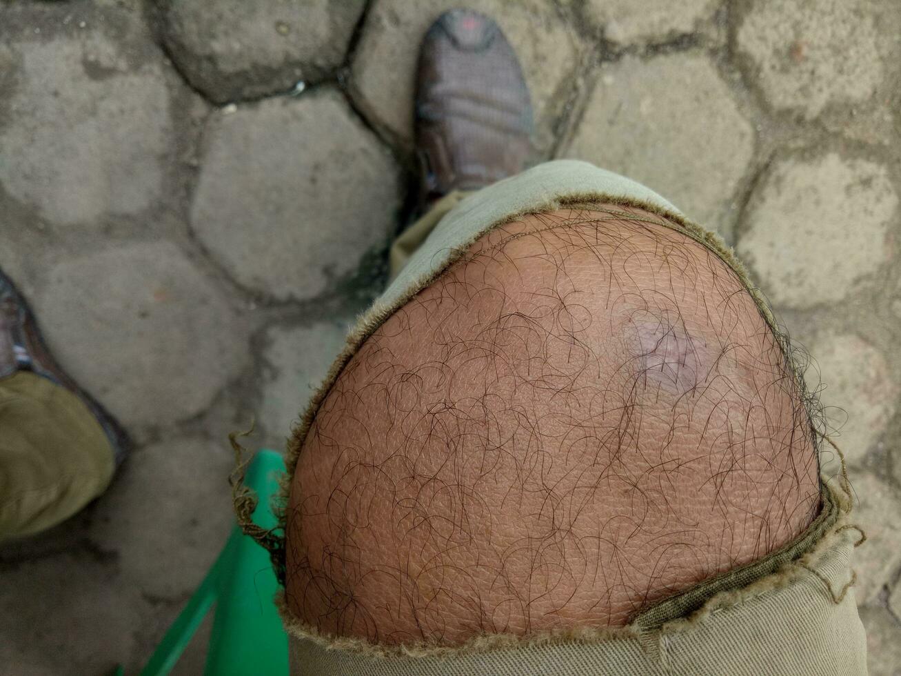 Photo of a boy's leg wearing torn brown trousers against a hexagonal brick floor in the background