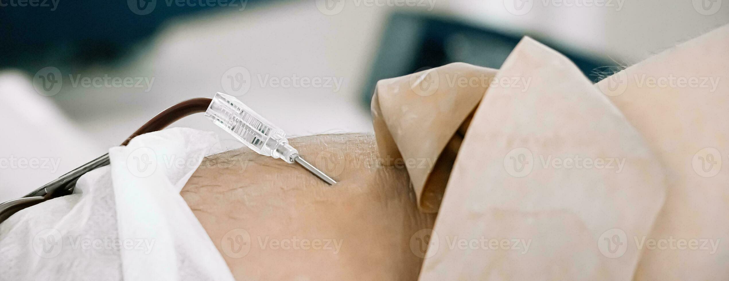 Catheter in vein close-up. International Blood Donation Day. photo