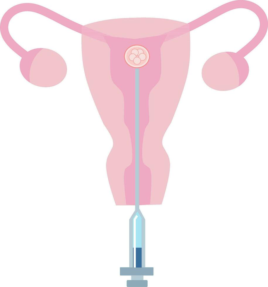 ET Embryo Transfer vector illustration. Perfect for presenting anything about reproduction, insemination or ivf.