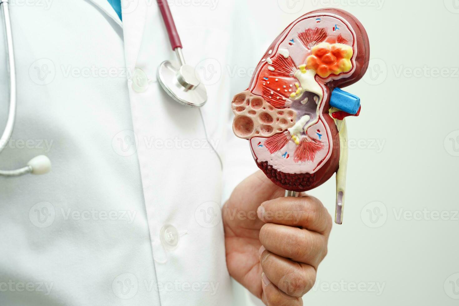 Chronic kidney disease, doctor holding model for treatment urinary system, urology, Estimated glomerular filtration rate eGFR. photo