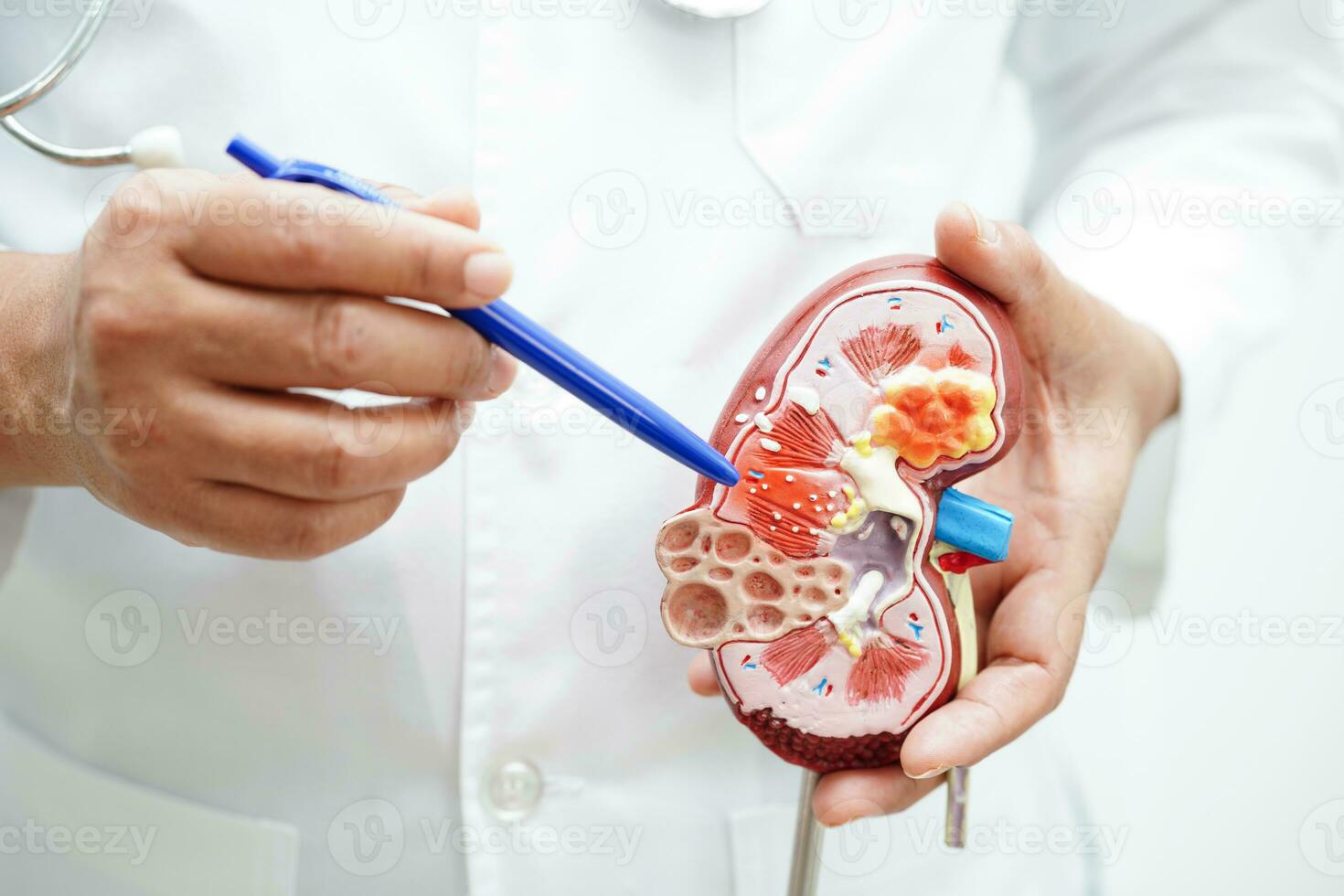 Chronic kidney disease, doctor holding model for treatment urinary system, urology, Estimated glomerular filtration rate eGFR. photo