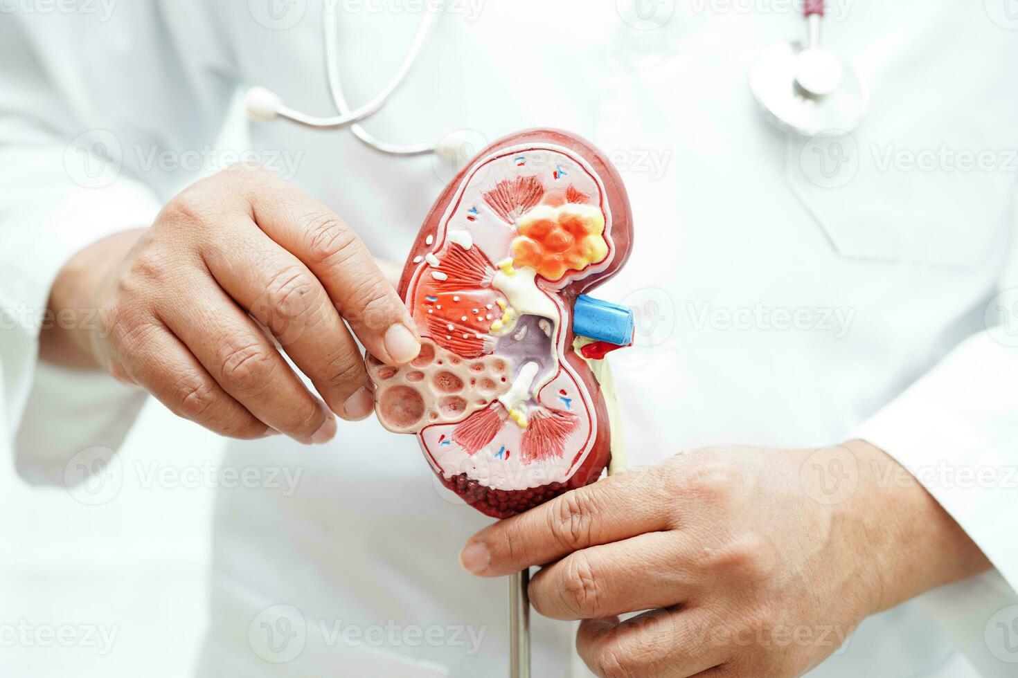 Chronic kidney disease, doctor holding model for treatment urinary system, urology, Estimated glomerular filtration rate eGFR. photo