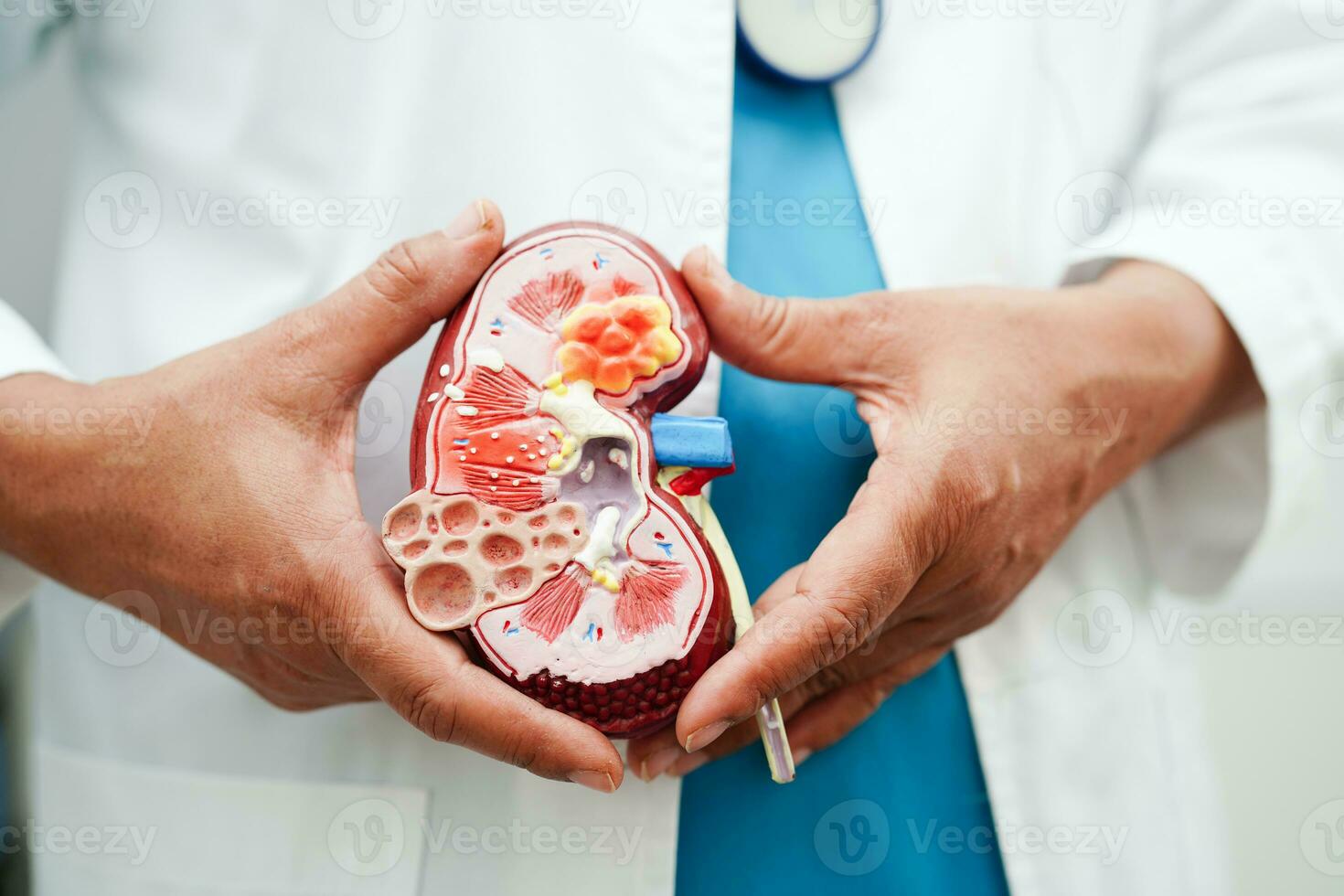 Chronic kidney disease, doctor holding model for treatment urinary system, urology, Estimated glomerular filtration rate eGFR. photo