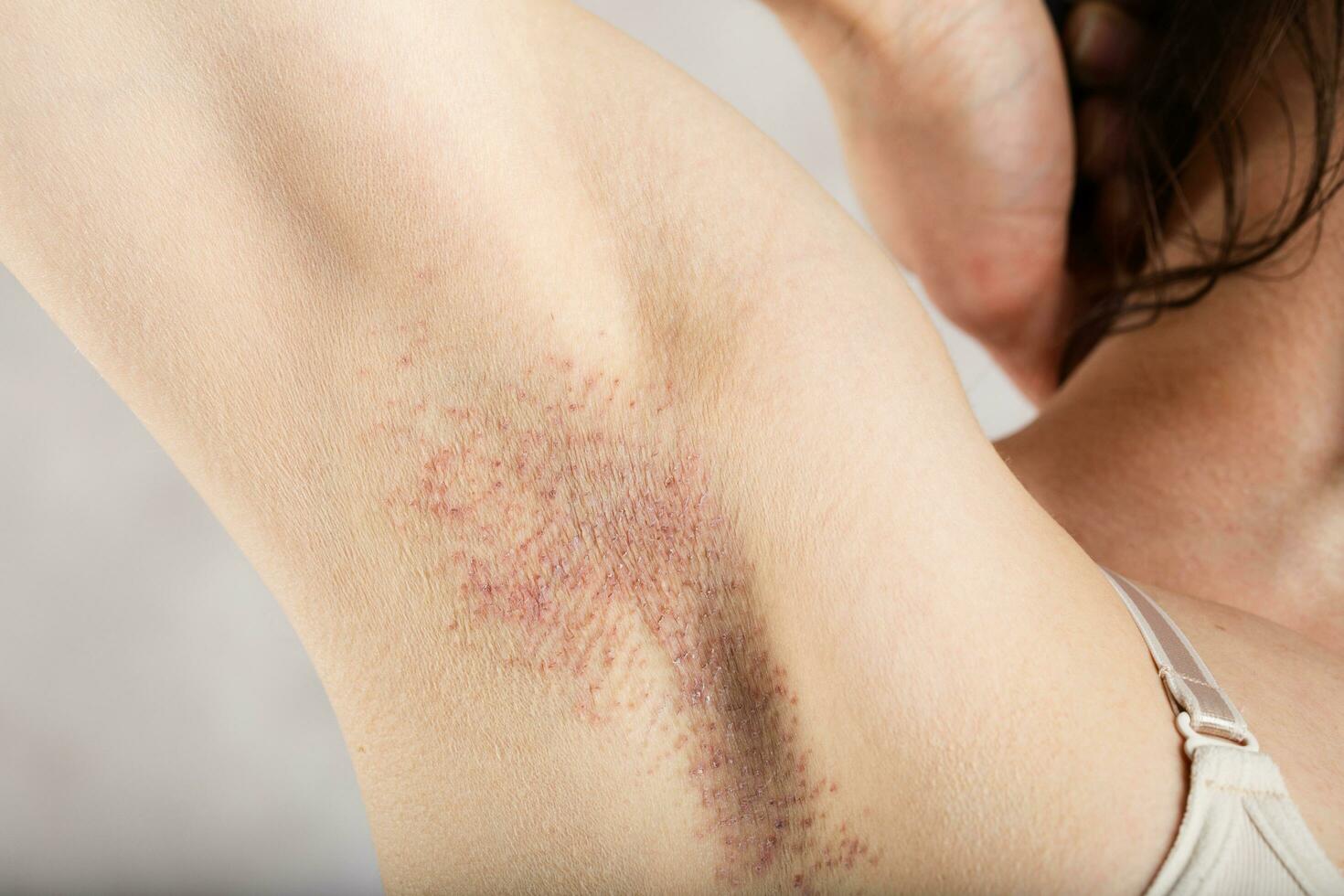 Three days after needle epilation in armpit zone. photo