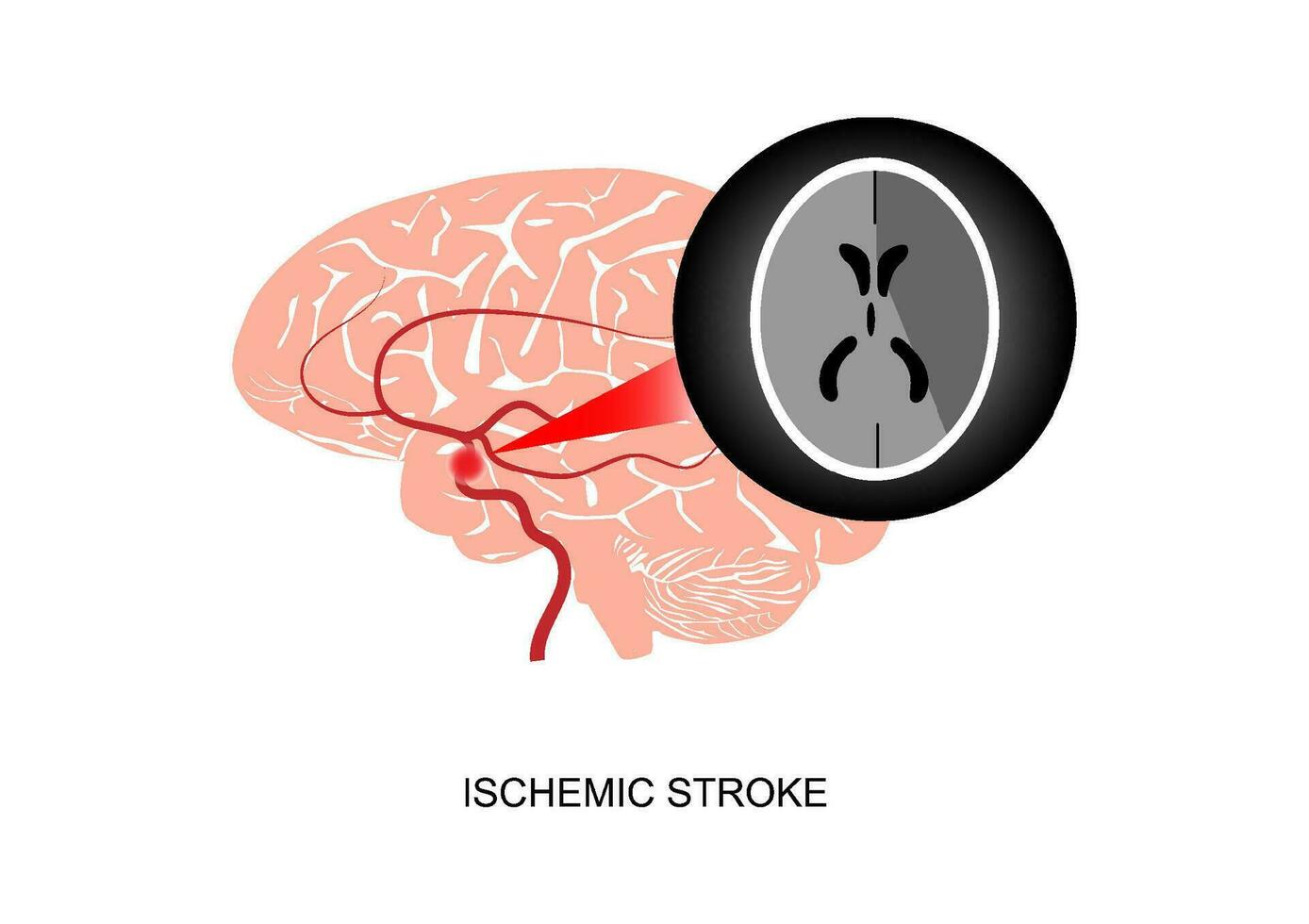 Illustration of cerebral ischemic stroke and imaging vector