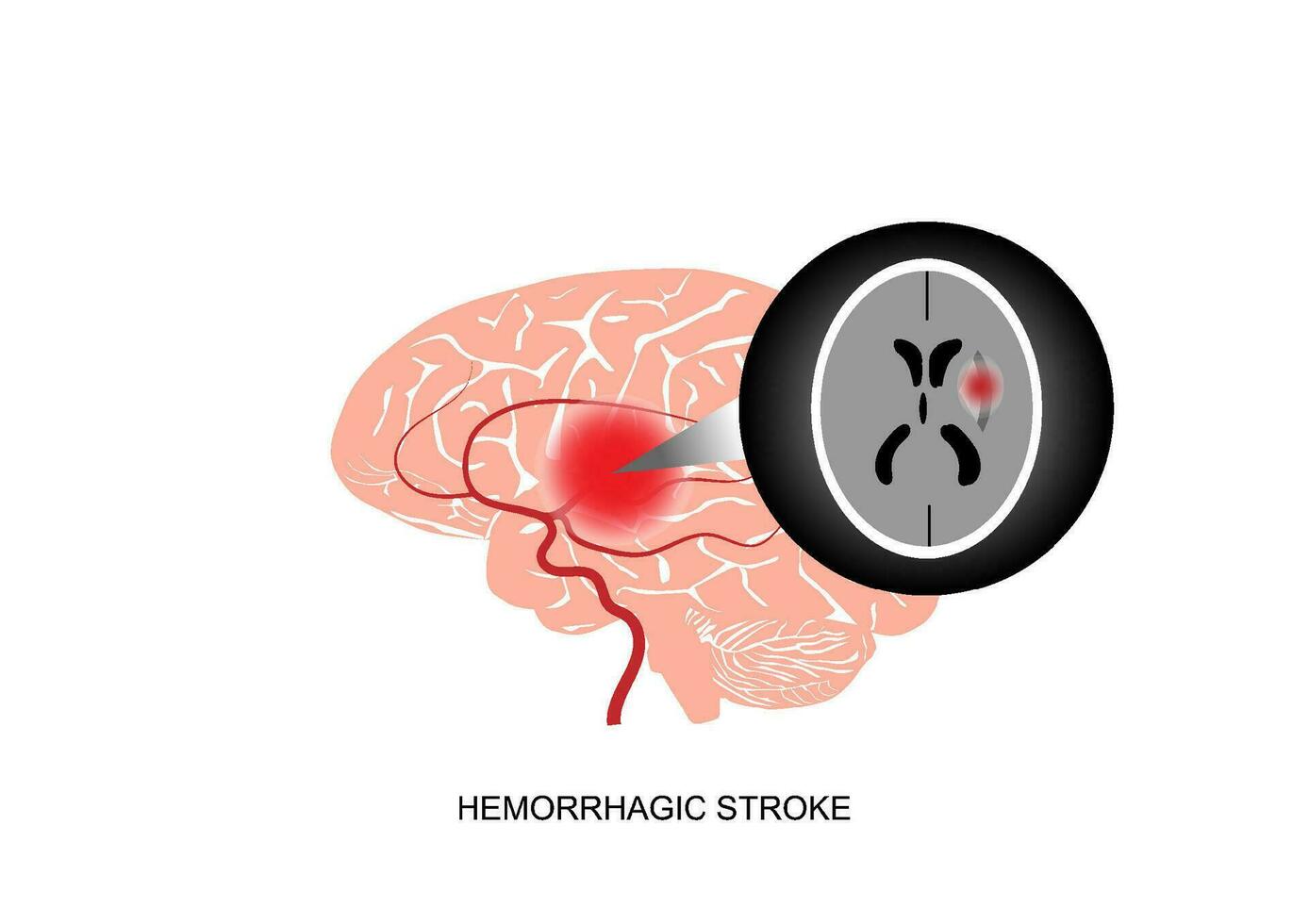 ilustración de cerebral hemorrágico carrera y cerebro formación de imágenes vector