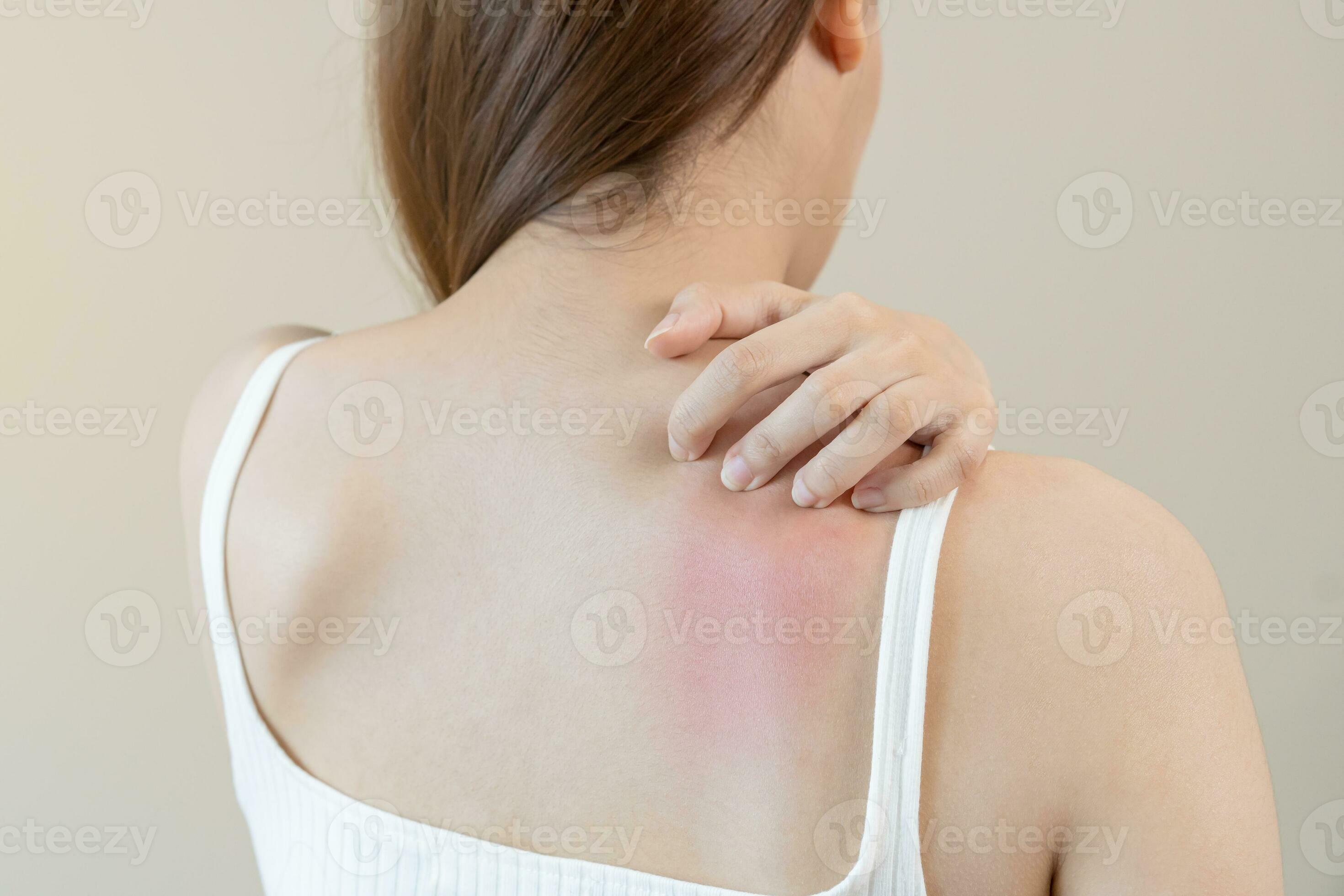 Dermatology, asian young woman, girl allergy, allergic reaction from atopic, insect bites on her