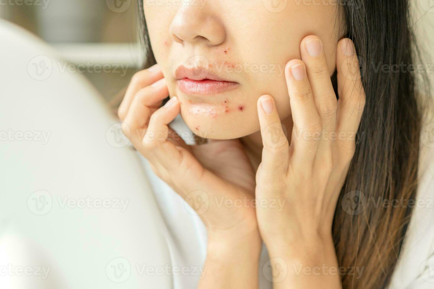 Expression worry asian young woman hand touching pustule around the