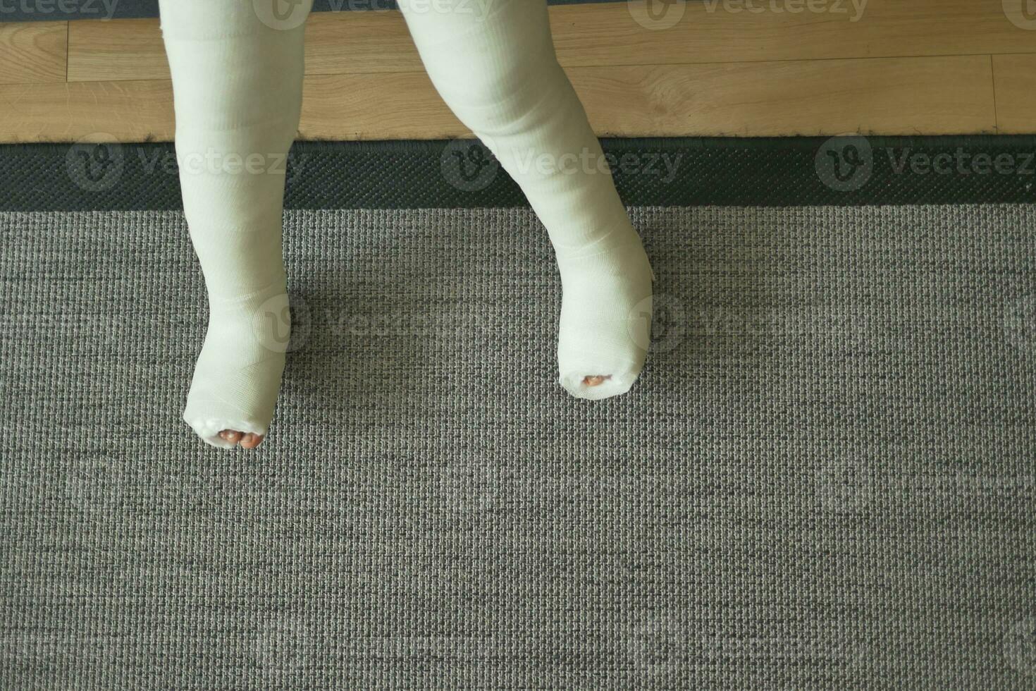 little child with plaster bandage on leg. photo