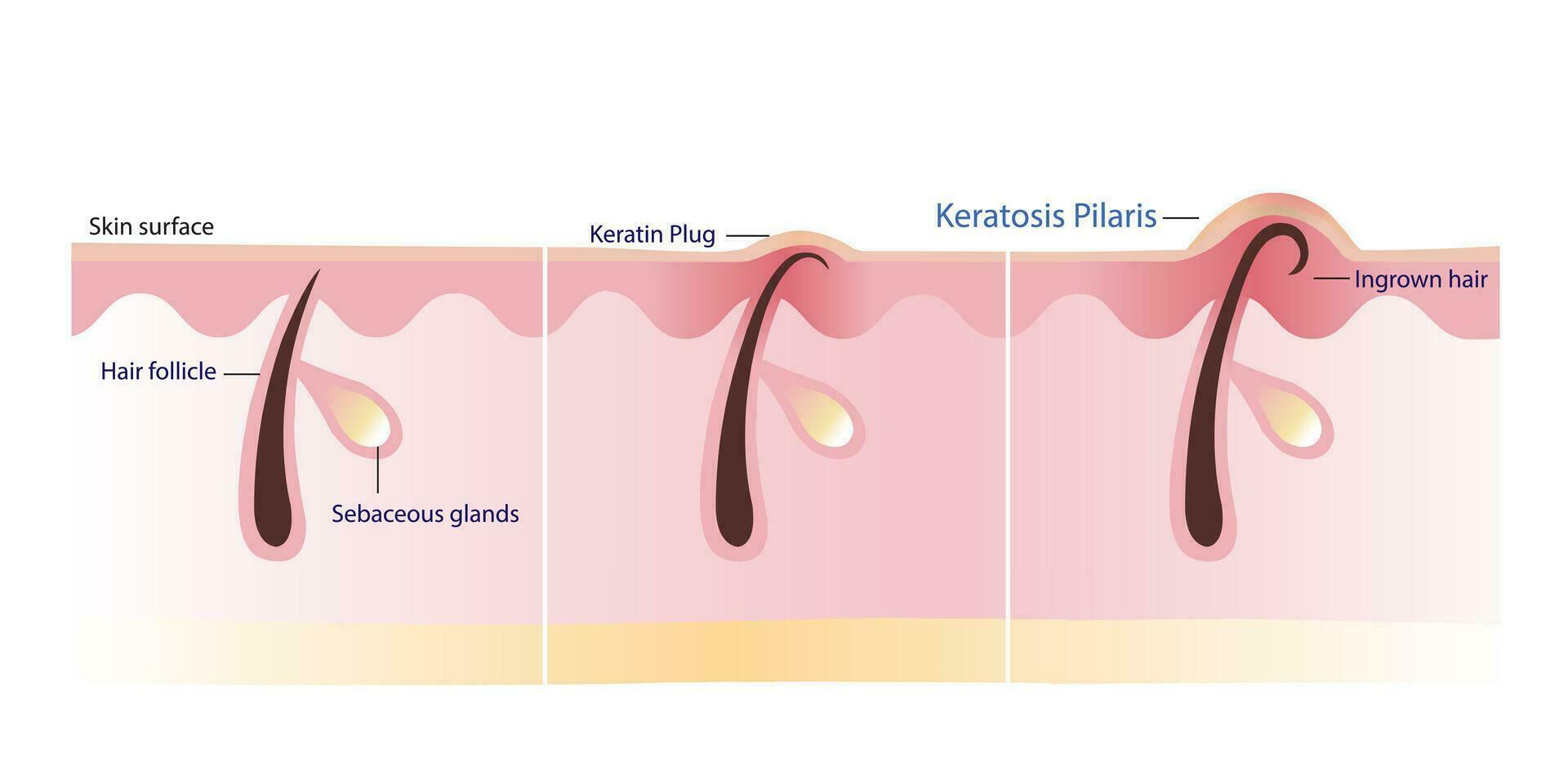 The process of Keratosis Pilaris vector illustration isolated on white background. Cross section of Keratin plug, Ingrown hair, Chicken skin and Bumpy skin. Atopic Dermatitis Infographic.