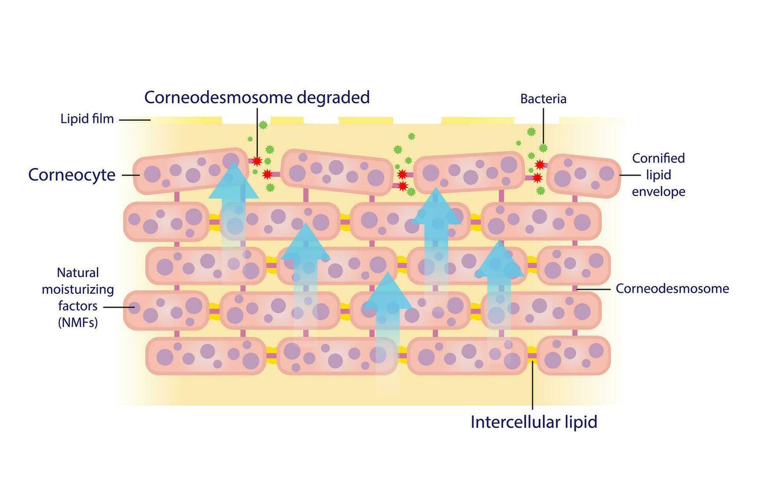 The mechanism of exfoliating corneocyte, skin cells vector isolated on white background. Corneodesmosome degraded by enzymes, sebum barrier decreased. This allows bacteria to get in skin easier.