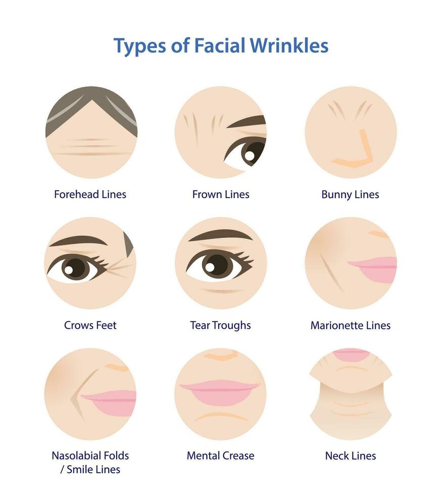 Types of facial wrinkles vector icon set on white background. Icon set of Forehead, Bunny, Marionette, Frown lines, Mental crease, Crows feet, Tear troughs, Nasolabial folds, Smile and Neck lines.
