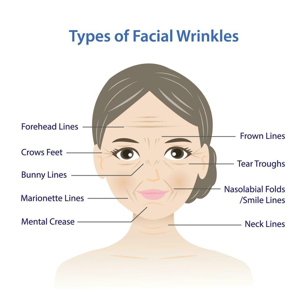 Types of facial wrinkles vector illustration isolated on white background. Forehead, Bunny, Marionette, Frown  lines, Mental crease, Crows feet, Tear troughs, Nasolabial folds, Smile and Neck lines.