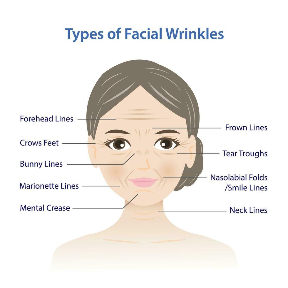 tipos de facial arrugas vector ilustración aislado en blanco antecedentes. frente, conejito, marioneta, fruncir el ceño líneas, mental pliegue, cuervos pies, lágrima bebederos, nasolabial pliegues, sonrisa y cuello líneas.