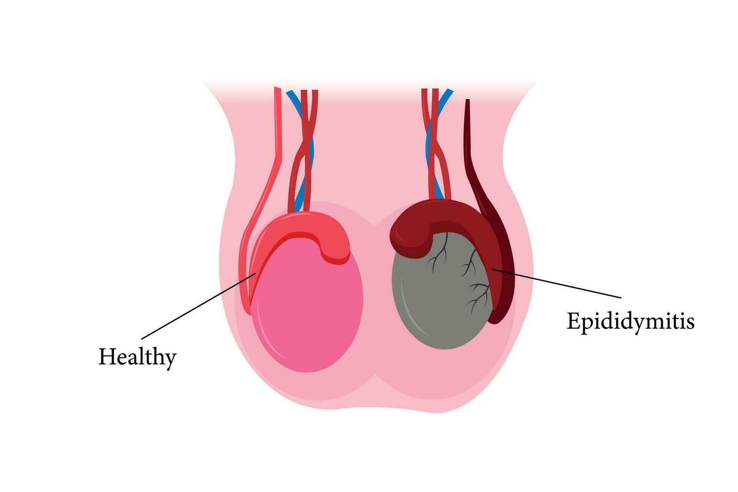 illustration of epididimitis. inflamasi epididimis. Epididymitis is inflammation of the epididymis which is generally caused by a bacterial infection vector