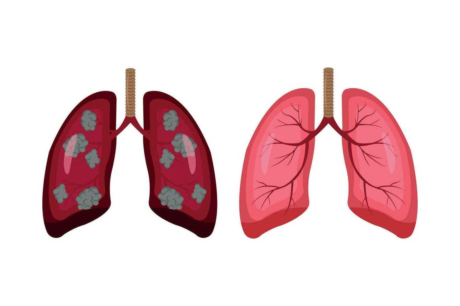 lung cancer and normal lung illustration comparation. eps 10. icon set vector