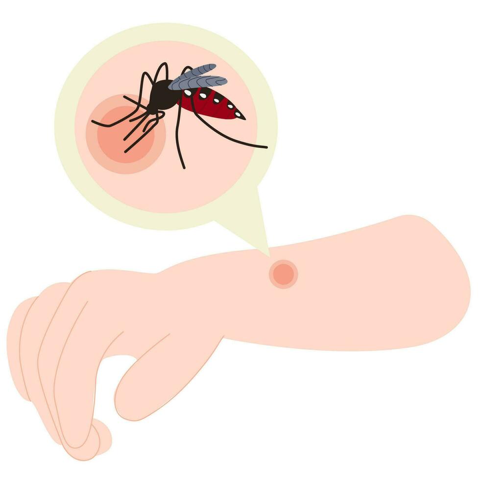 The human hand with the mosquito bite. Mosquito bite hand. Mosquito  bite. Healthcare illustration. vector