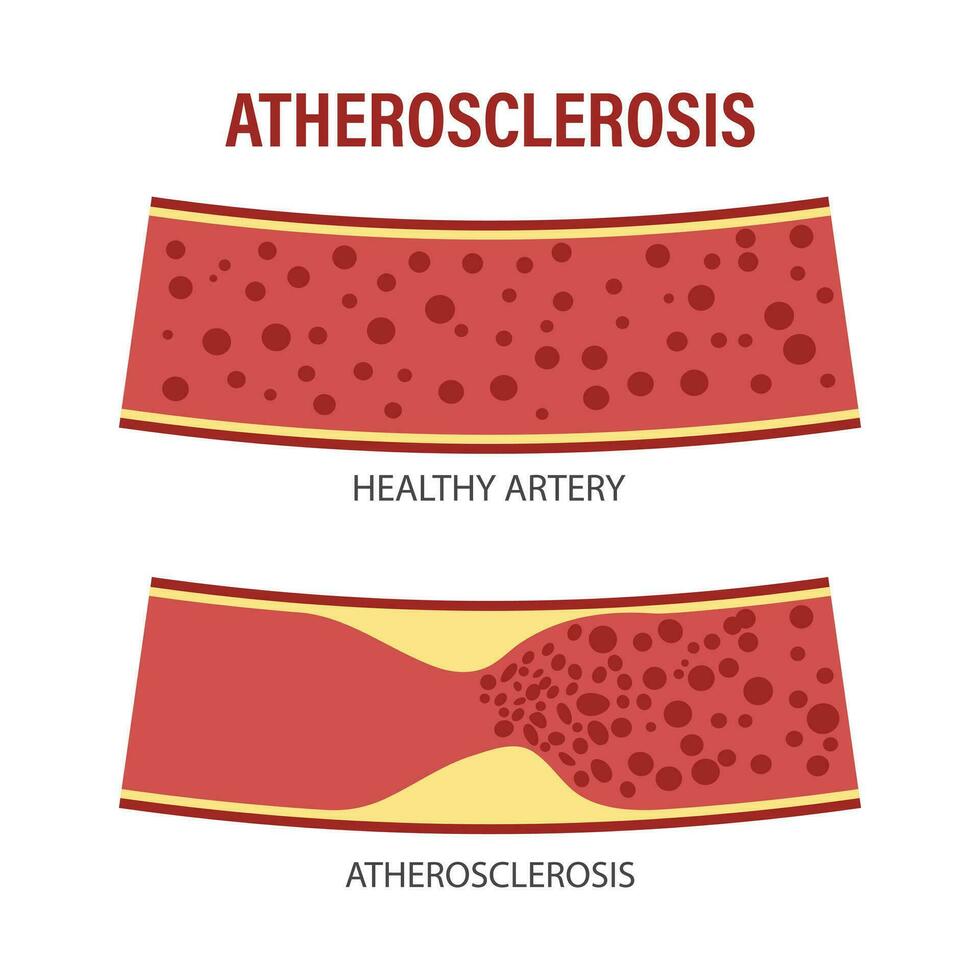 sano y aterosclerótico vasos con sangre células. colesterol en sangre vasos aterosclerótico placa. medicamento, ciencia, cuidado de la salud. infografia bandera vector