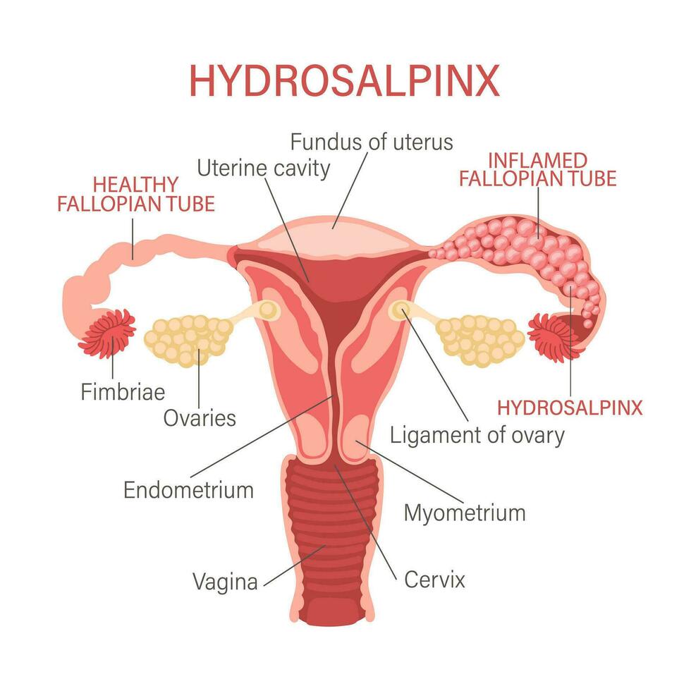 Hydrosalpinx. The fallopian tubes are blocked and filled with serous or clear fluid. Gynecology. Medicine. Infographics banner, vector. vector