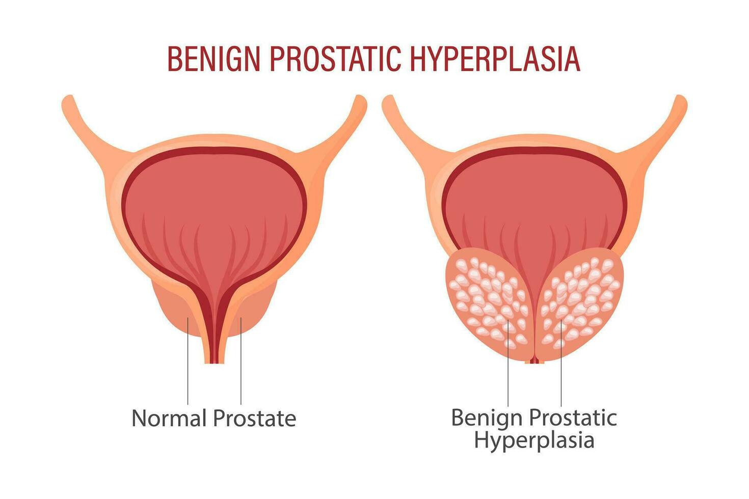 Benign prostatic hyperplasia. Anatomy of human organs. Medicine, healthcare and science concept. Education infographics banner vector