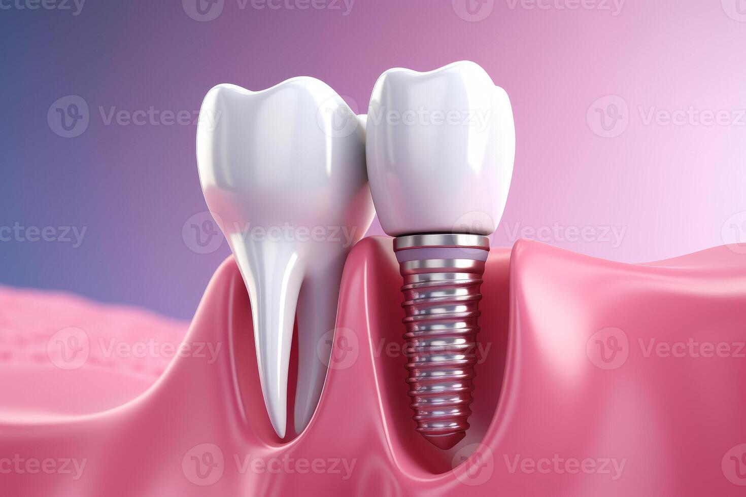 Dental implantation, teeth with implant screw, illustration. photo
