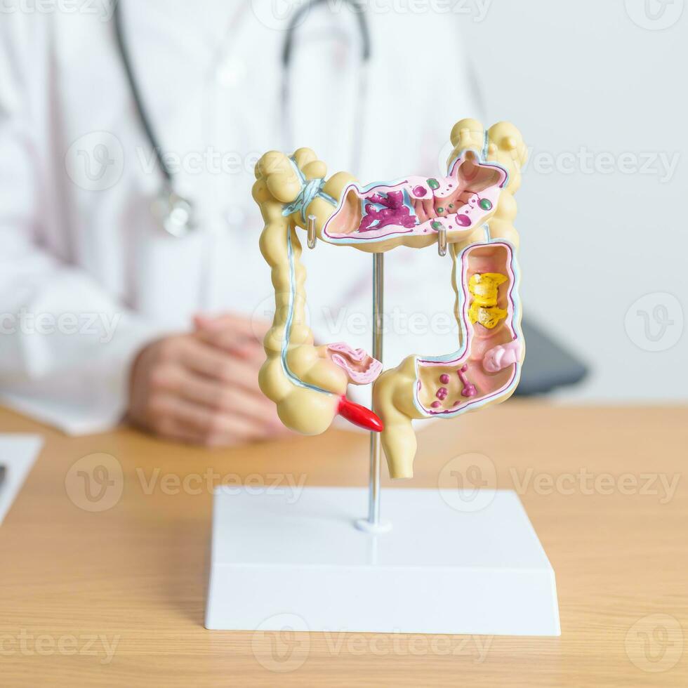 médico con humano colon anatomía modelo. colónico enfermedad, grande intestino, colorrectal cáncer, ulcerativo colitis, diverticulitis, irritable intestino síndrome, digestivo sistema y salud concepto foto