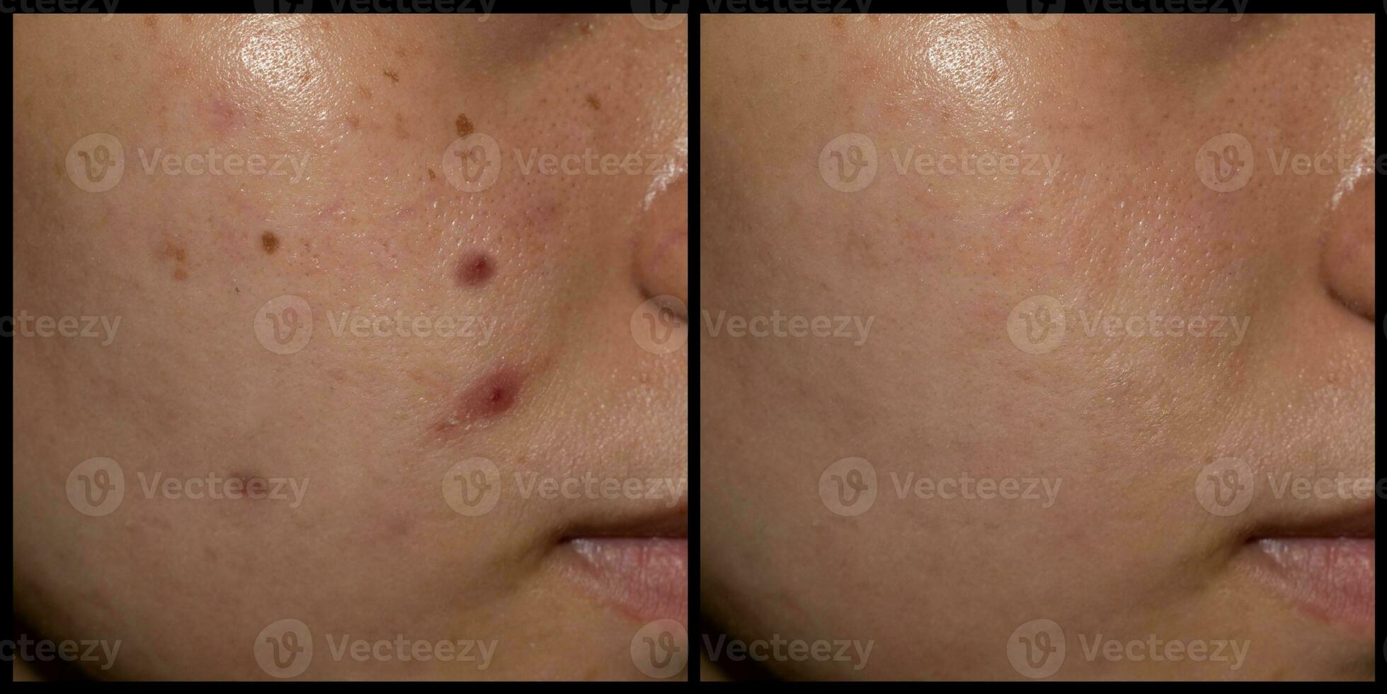 Before and after treatment of acne, black spots and freckles on face of Asian woman. photo