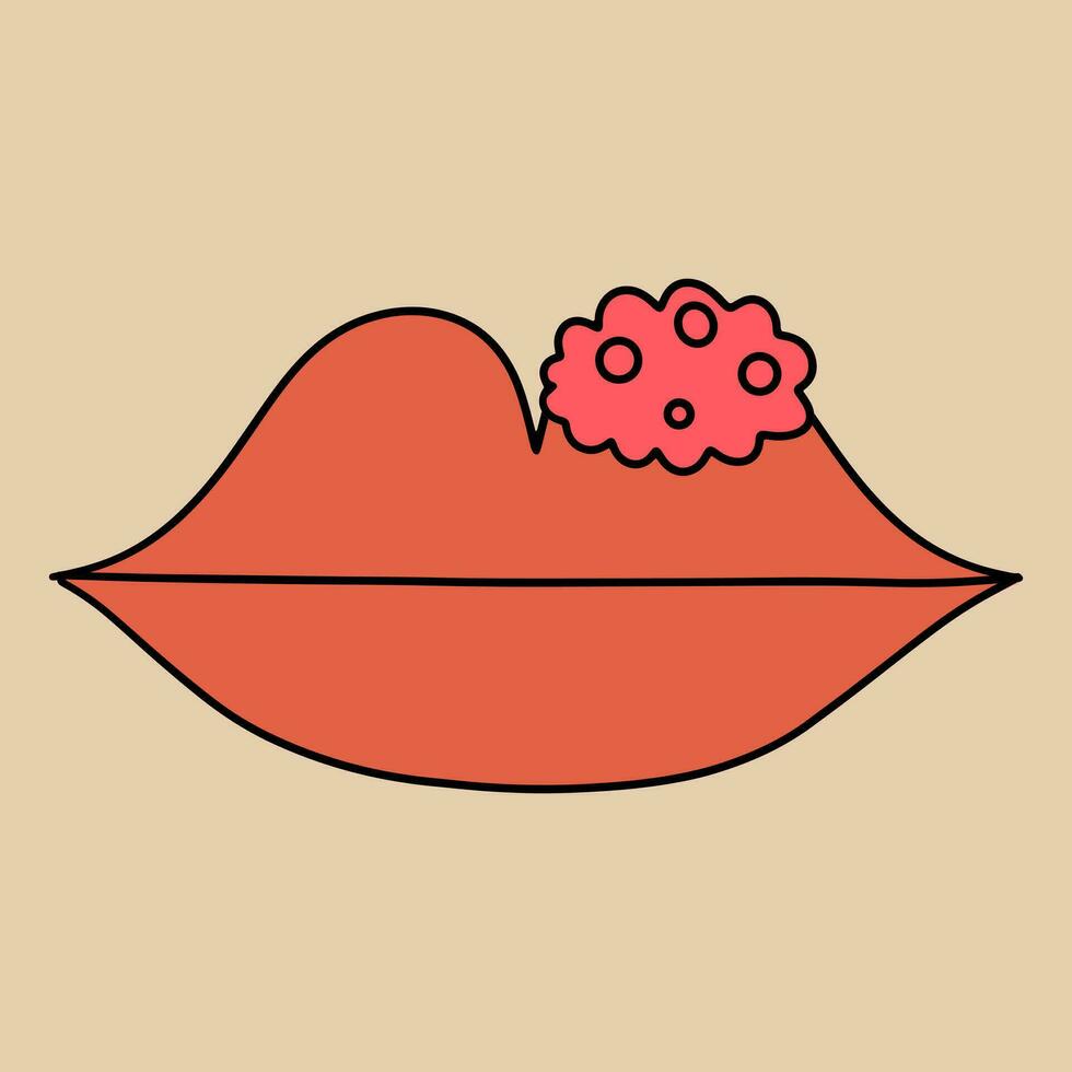 Herpes virus on the upper lip. Vector illustration in flat style
