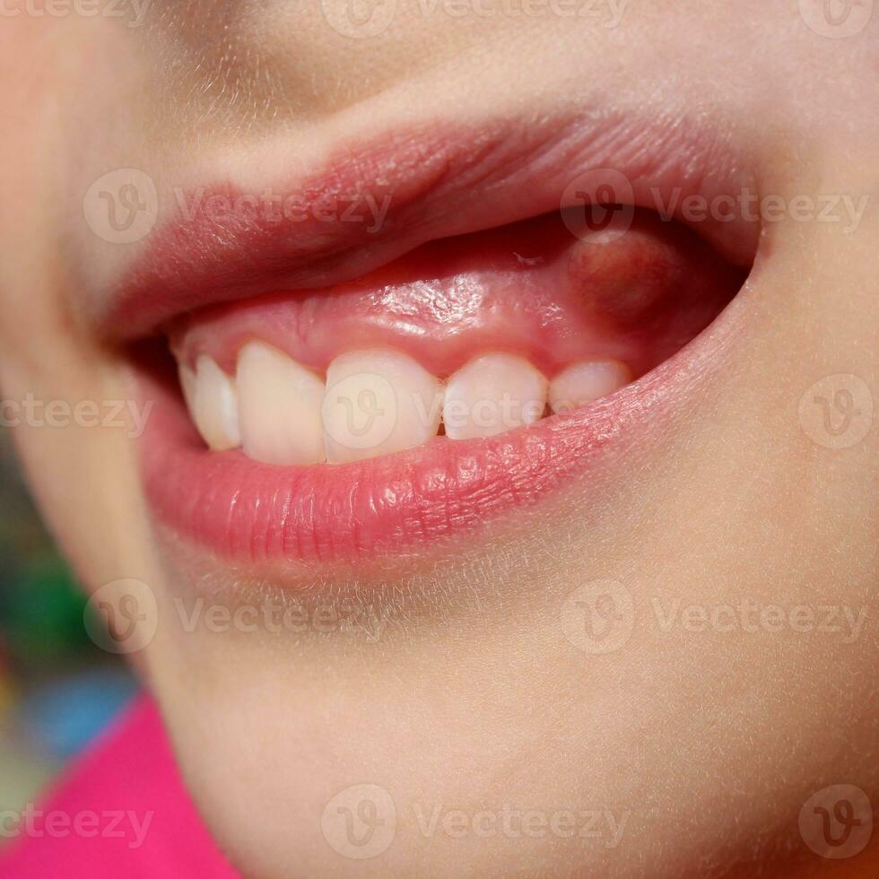 Swelling on gums the child. photo
