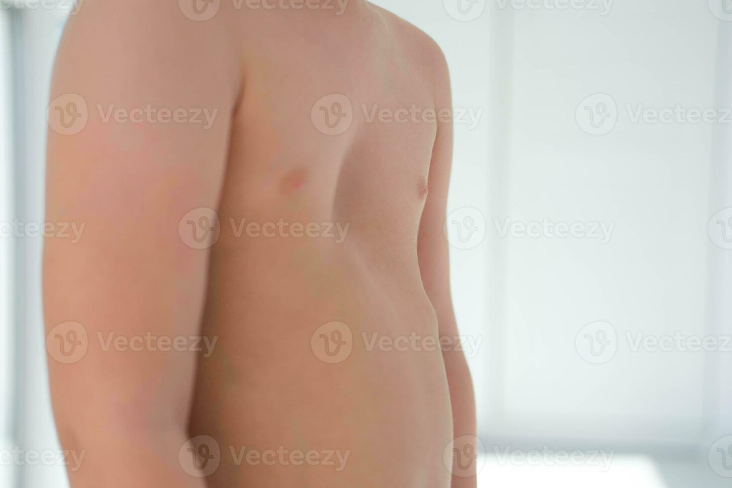 A child with a pectus excavatum. Rickets is a consequence of vitamin D deficiency. photo
