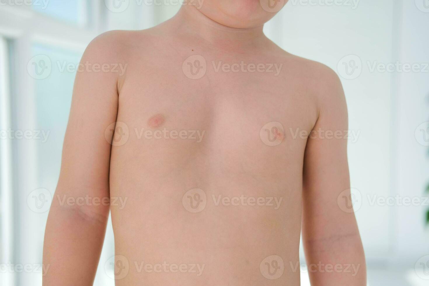 un niño con un pectus excavatum. raquitismo es un consecuencia de vitamina re deficiencia. foto