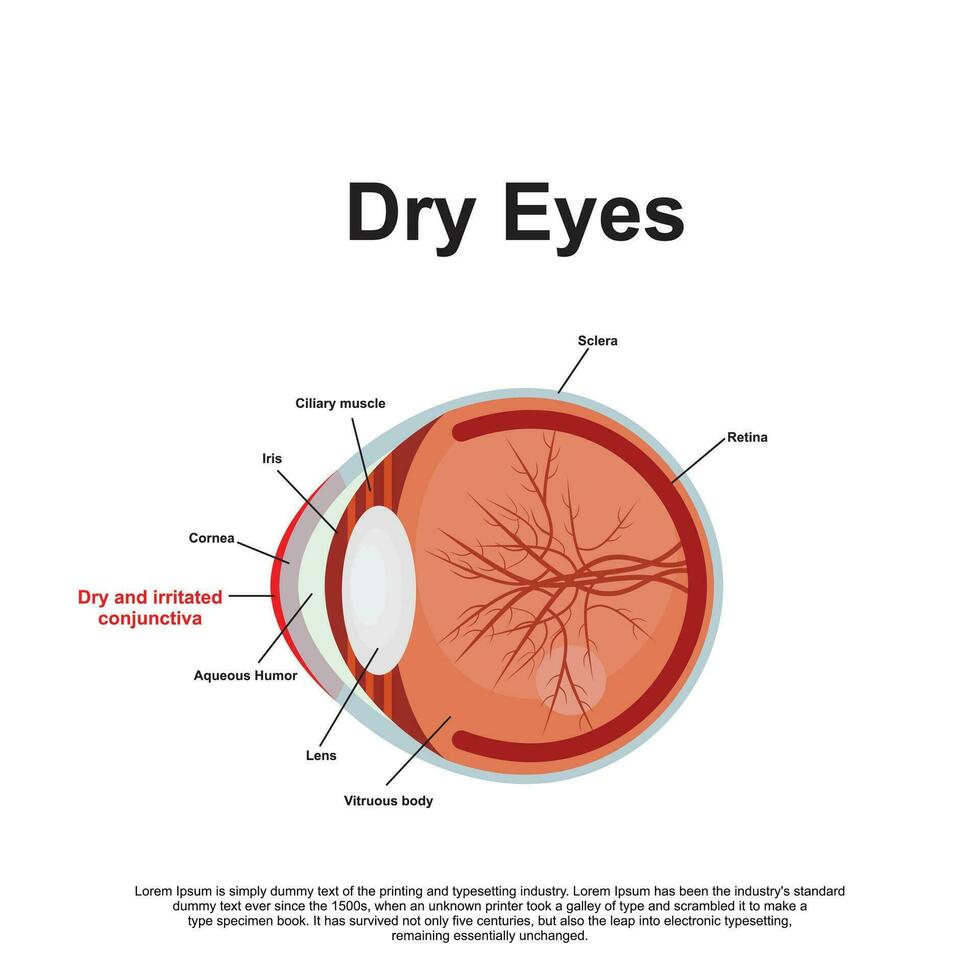 Dry Eyes Anatomy Vector Illustration