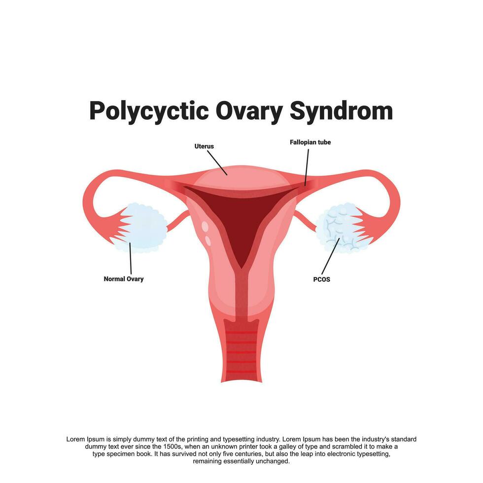 Polycystic ovary syndrome vector illustration