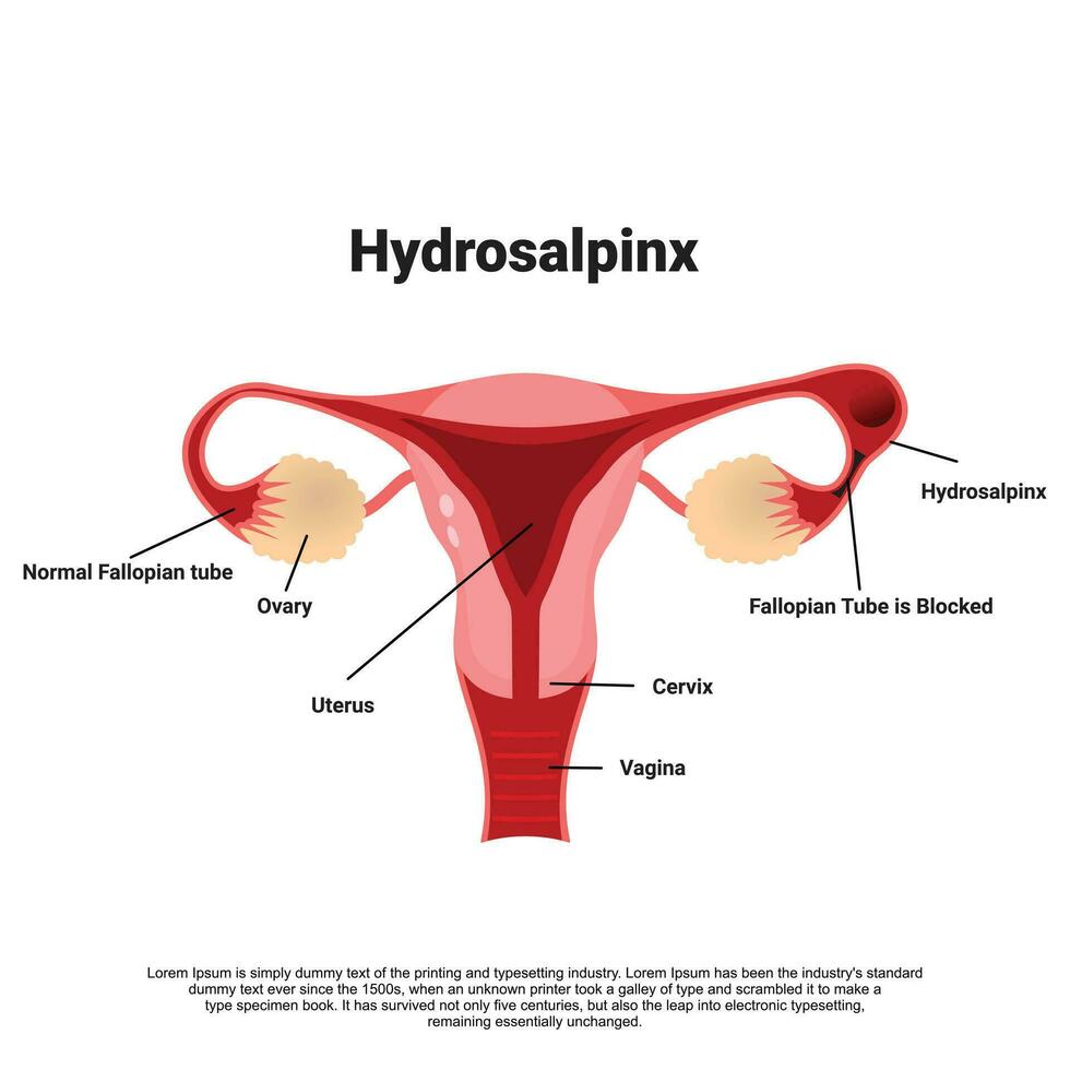 Hydrosalpinx diagram, Obstructed Follopian tube, Infection or membrane covering the fallopian tube cause blockage vector