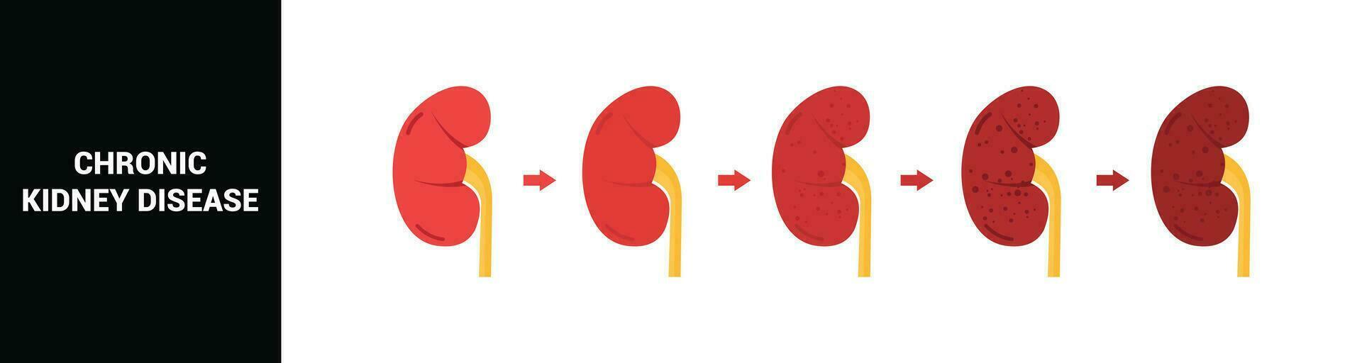 Chronic kidney disease vector illustration
