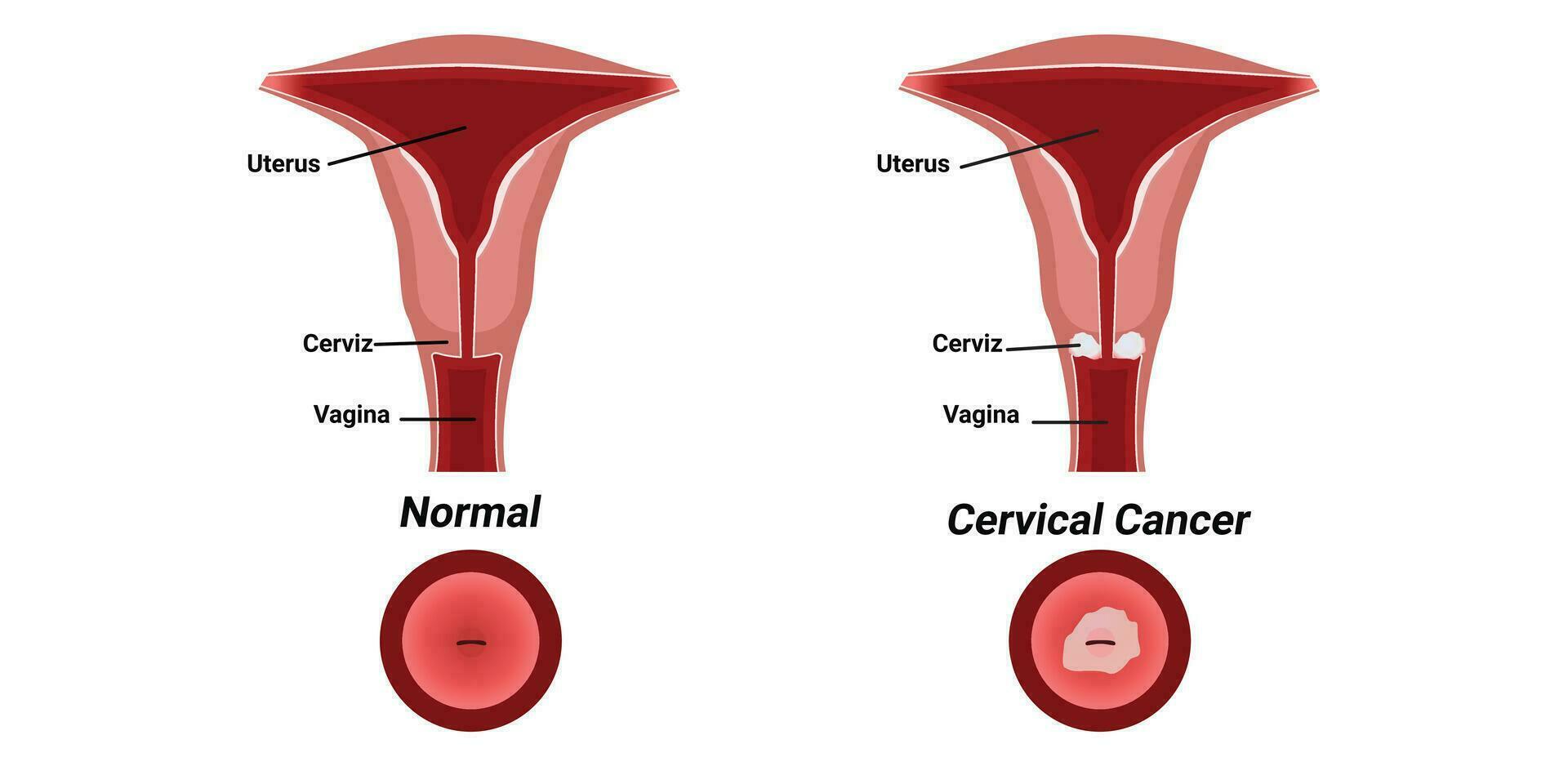 Illustration of cervical cancer vector