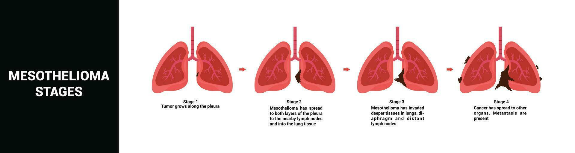 mesotelioma cáncer etapas vector ilustración
