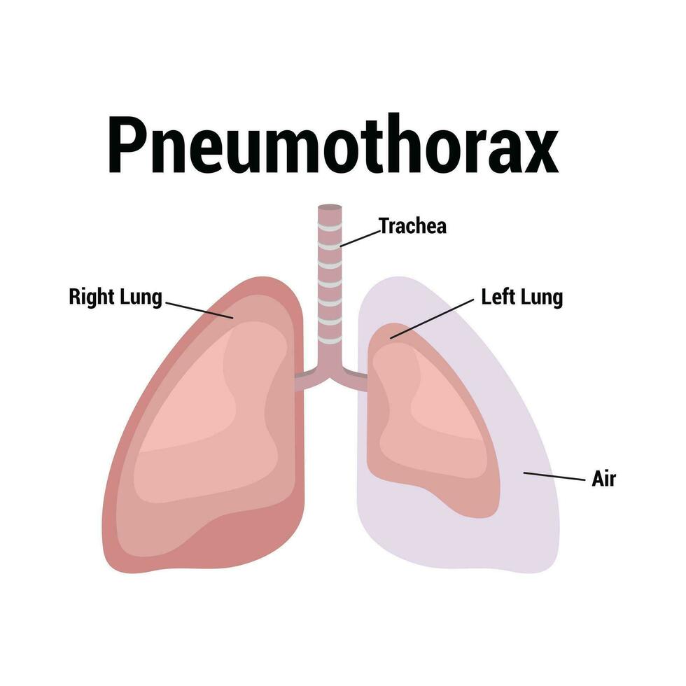 symptoms of pneumothorax lung vector