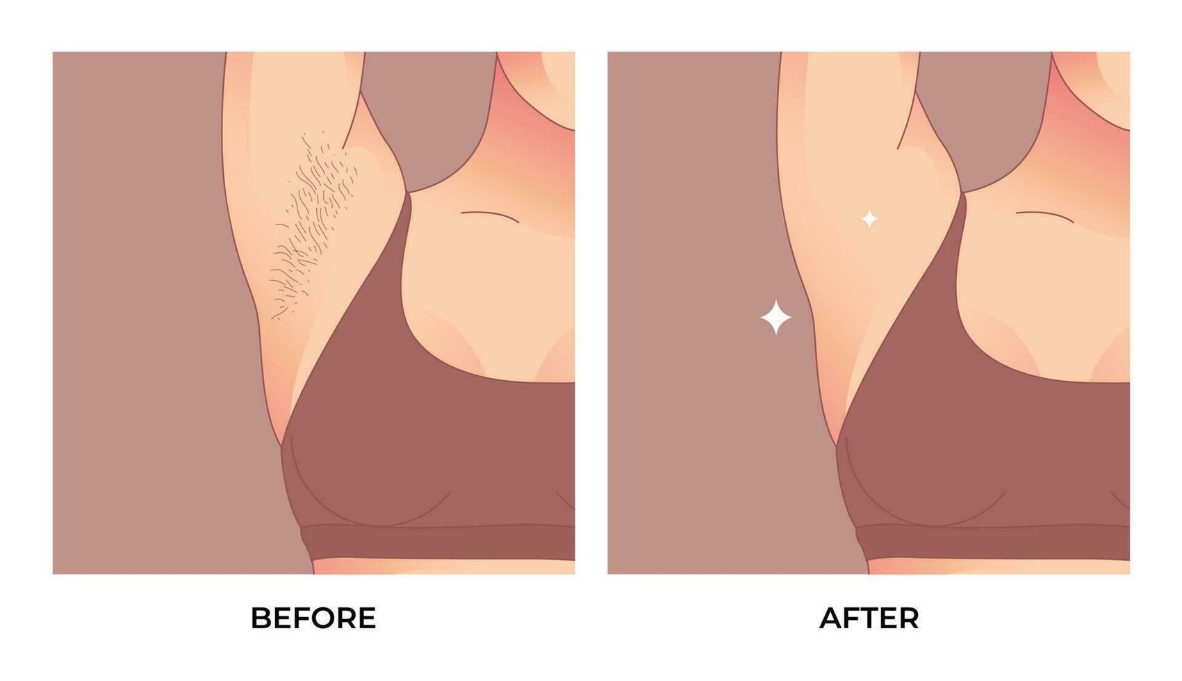 Armpit Hair before and after depilation, laser waxing and sugaring. vector