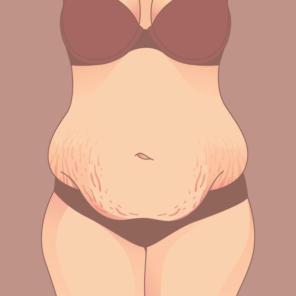 Belly with stretch marks, Saggy skin removal. woman body shape transformation, Fat To Fit. vector