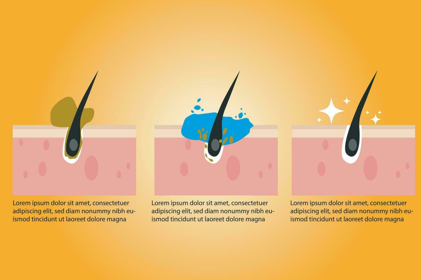 limpieza espinillas proceso plano ilustración. obstruido poros eliminación, piel limpieza espuma, protección de la piel vector ilustración