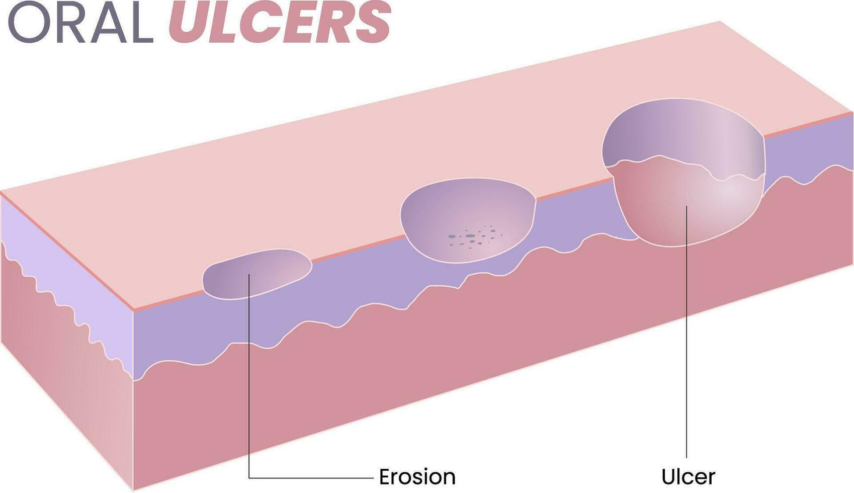 illustration of oral ulcer diagram vector