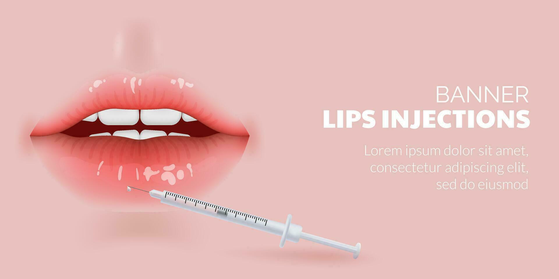 3D illustration of realistic lips undergoing a cosmetic procedure for aging care. Results of lip injections and wrinkle reduction, the correction and contouring of lips using fillers injection. vector