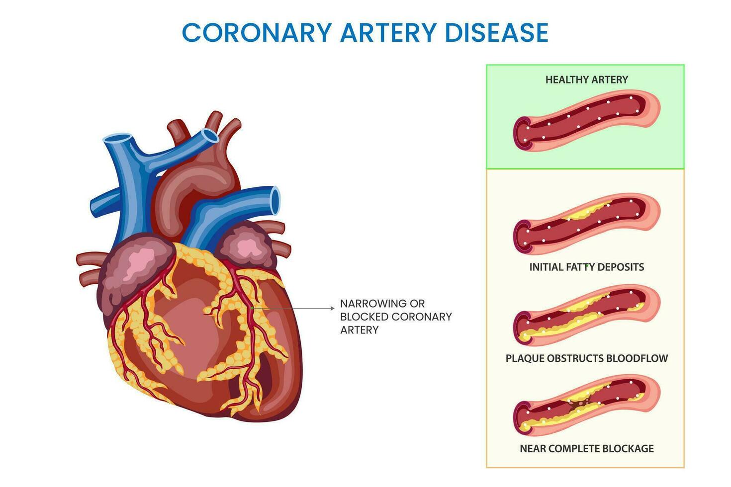 coronario artería enfermedad, estrechado arterias, reducido sangre fluir, aumentado riesgo de corazón complicaciones vector