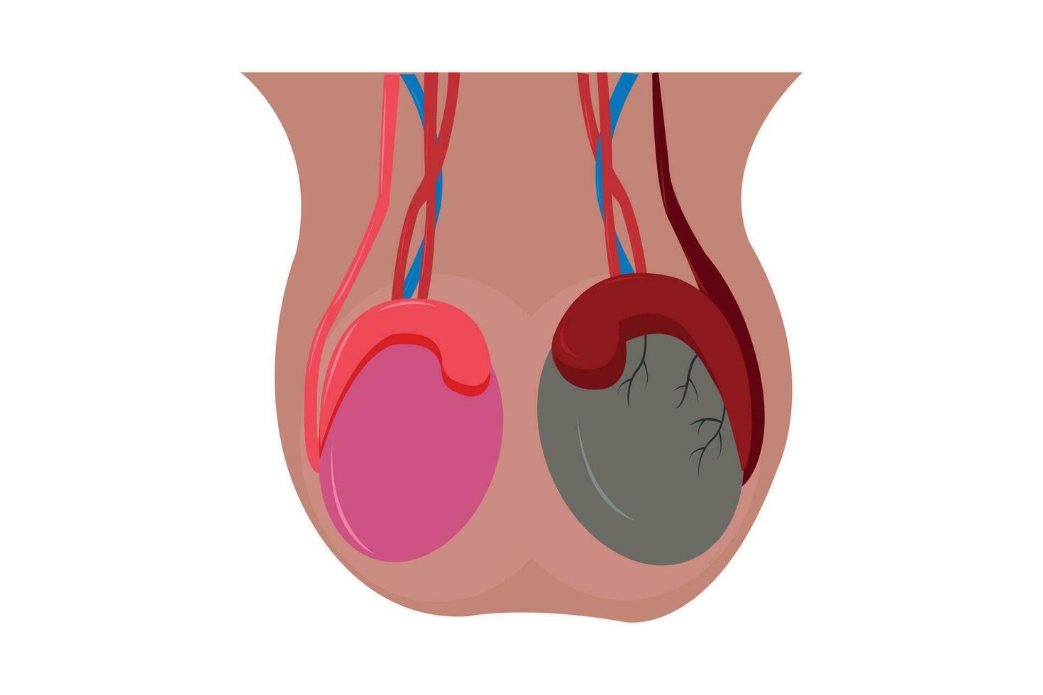 illustration of epididimitis .inflamasi epididimis. Epididymitis is inflammation of the epididymis which is generally caused by a bacterial infection vector