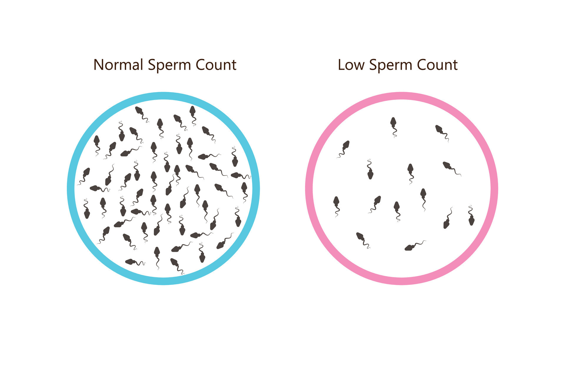 normal and low sperm count illustration. Male infertility oligospermia