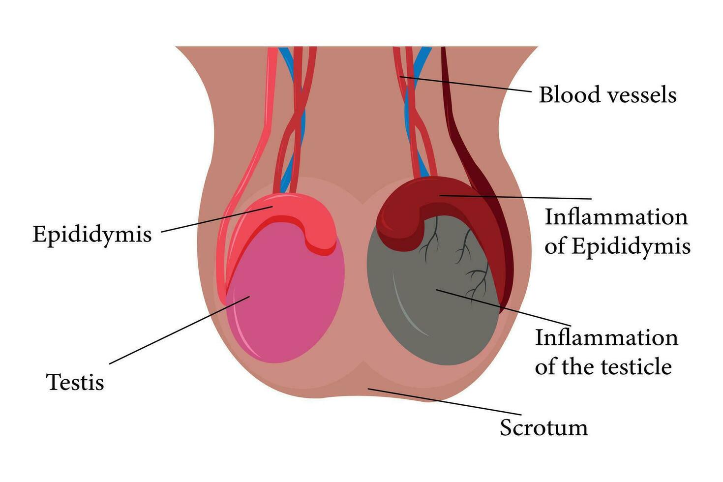 illustration of epididimitis. inflamasi epididimis. Epididymitis is inflammation of the epididymis which is generally caused by a bacterial infection vector