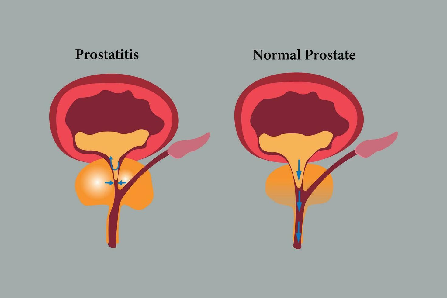 comparation of health prostate and unhealth prostate. prostatitis illustration icon set. eps 10 vector