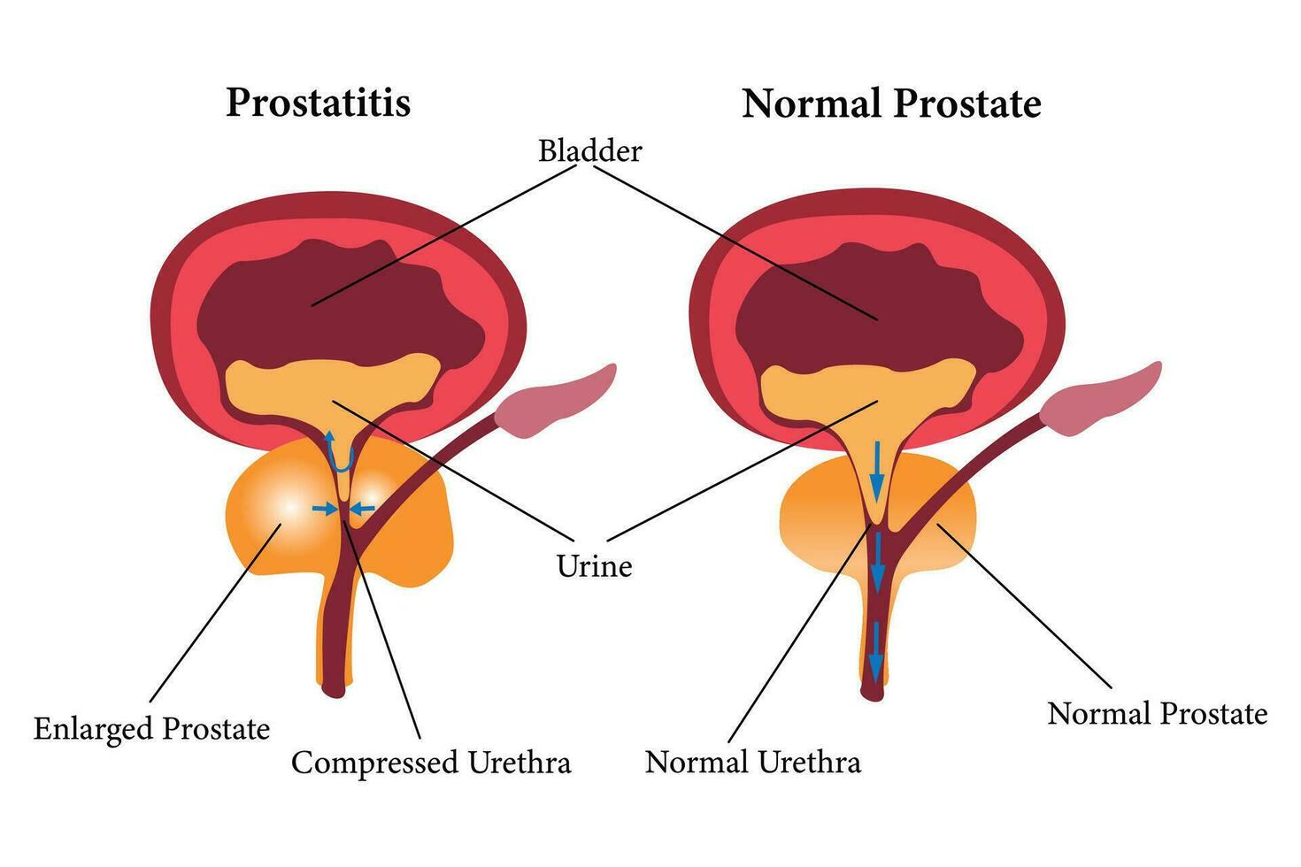 comparation of health prostate and unhealth prostate. prostatitis illustration icon set. eps 10 vector