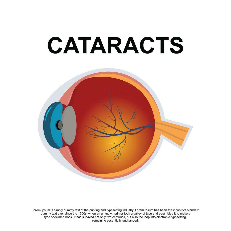 Cataract vector illustration in flat style